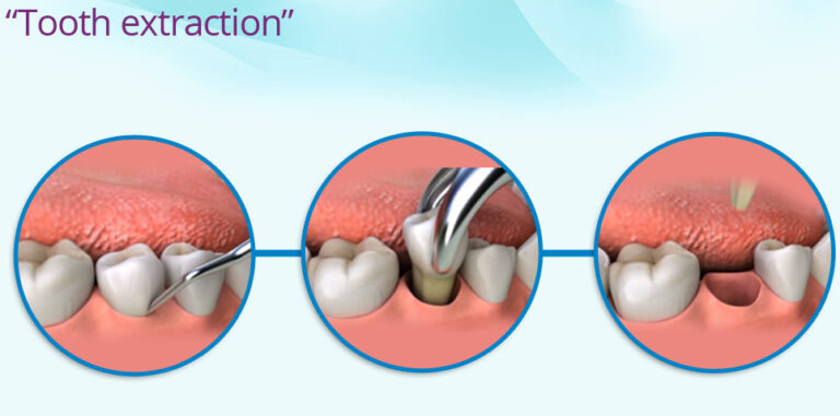 Painless Tooth Removal in Sanpada Navi Mumbai | Expert Extractions